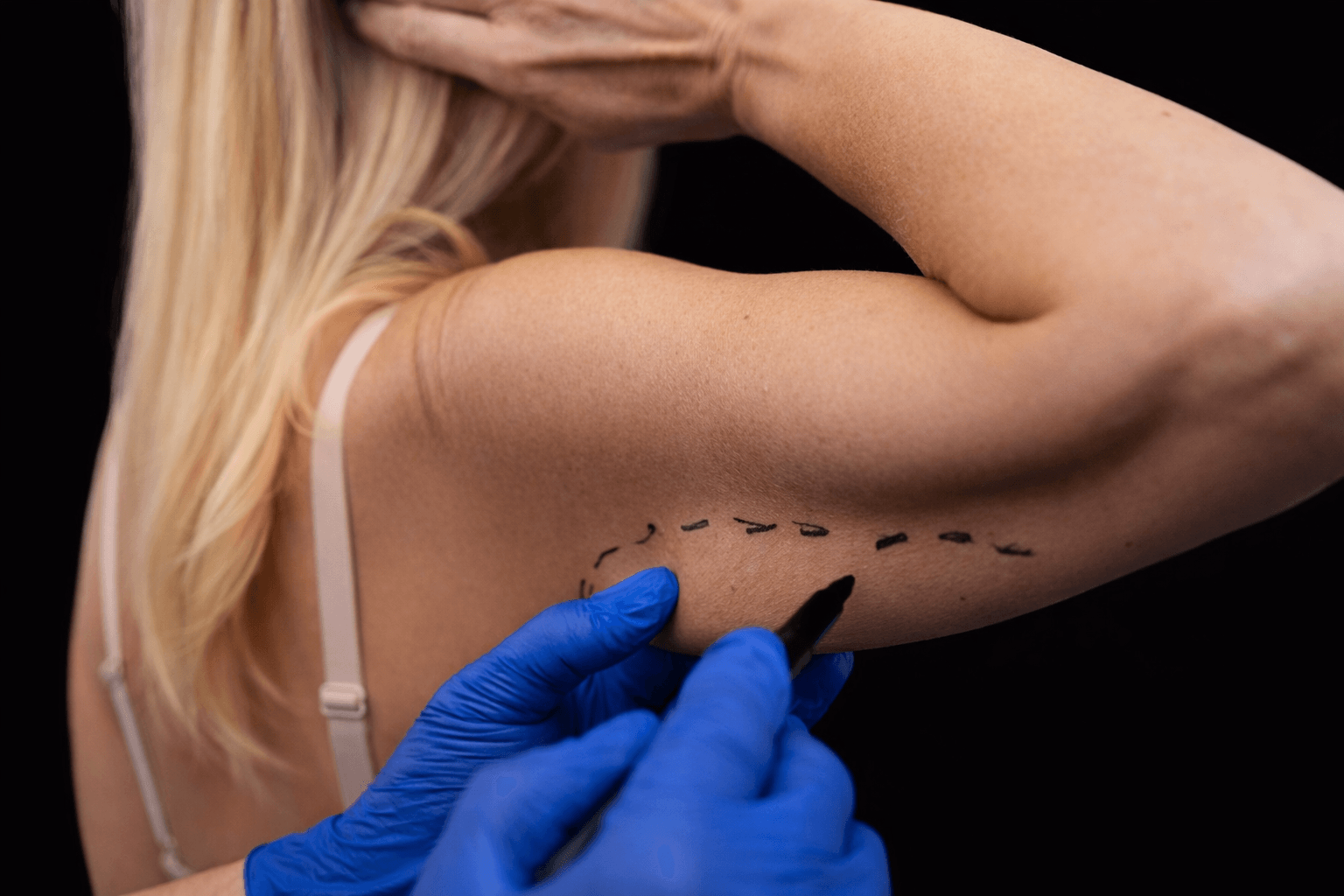 Lifting Braccia - Be Best Clinic®