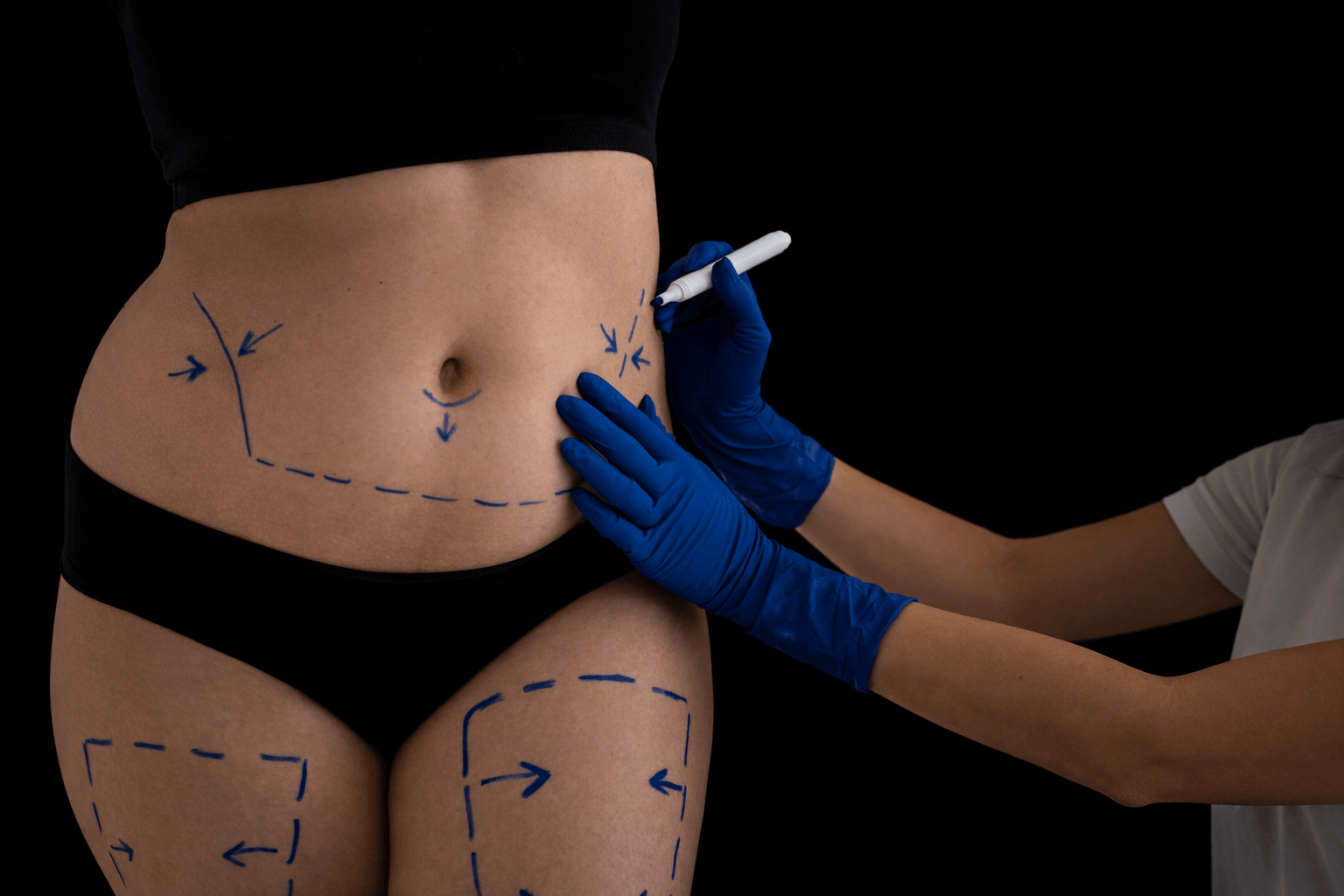 Liposuzione - Be Best Clinic®