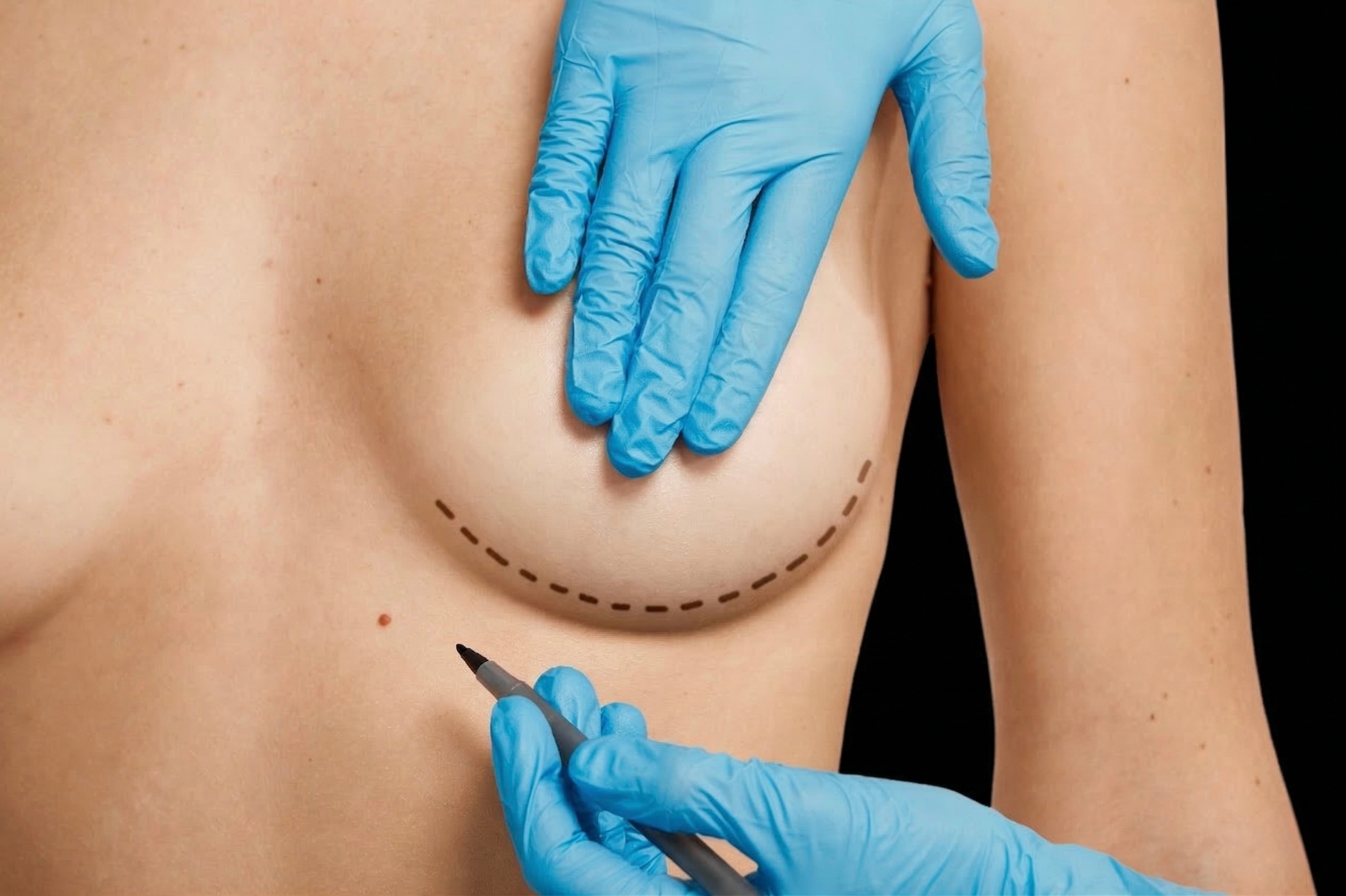 Mastoplastica Additiva - Be Best Clinic®