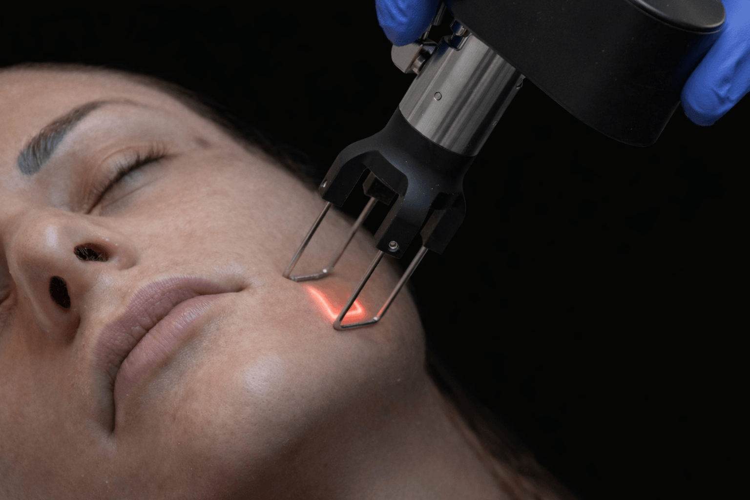 Resurfacing Viso Ablativo - Be Best Clinic®