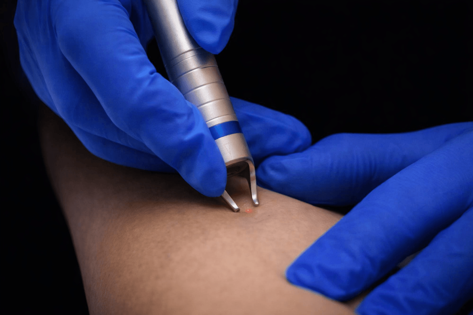 Laser Vascolare - Be Best Clinic®